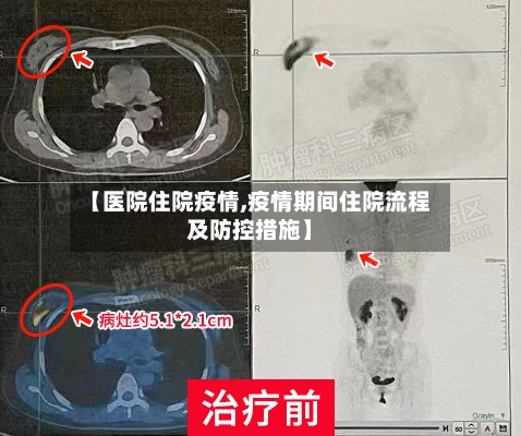 【医院住院疫情,疫情期间住院流程及防控措施】